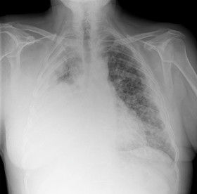 Chest x-ray showing extensive mesothelioma on the right side from asbestos exposure